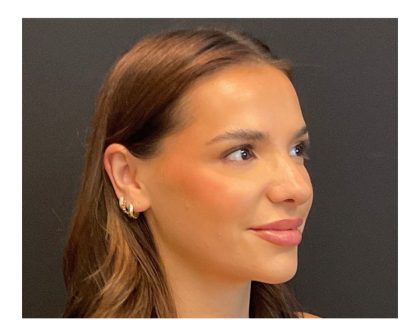 Rhinoplasty Before & After Patient #5646