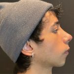 Rhinoplasty Before & After Patient #5647