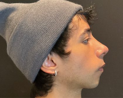 Rhinoplasty Before & After Patient #5647