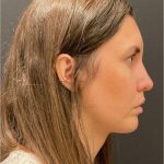Rhinoplasty Before & After Patient #5648