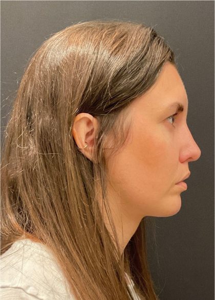 Rhinoplasty Before & After Patient #5648