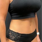 The Skinny Shot Before & After Patient #5475