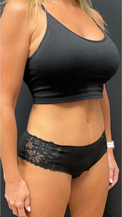 The Skinny Shot Before & After Patient #5475