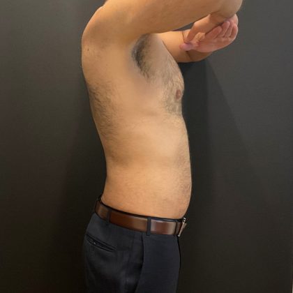 The Skinny Shot Before & After Patient #5479