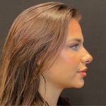 Rhinoplasty Before & After Patient #5646