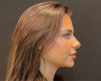 Rhinoplasty Before & After Patient #5646