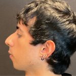 Rhinoplasty Before & After Patient #5647