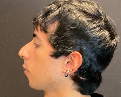 Rhinoplasty Before & After Patient #5647