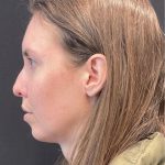 Rhinoplasty Before & After Patient #5648