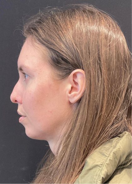 Rhinoplasty Before & After Patient #5648