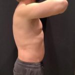 Liposuction Before & After Patient #6939