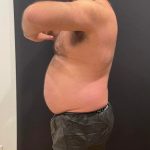 The Skinny Shot Before & After Patient #5479