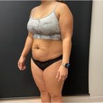 The Skinny Shot Before & After Patient #5477
