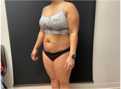 The Skinny Shot Before & After Patient #5477