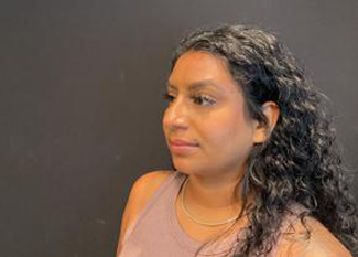 Rhinoplasty Before & After Patient #5365