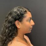 Rhinoplasty Before & After Patient #5365