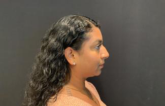 Rhinoplasty Before & After Patient #5365