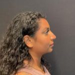Rhinoplasty Before & After Patient #5365