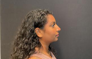 Rhinoplasty Before & After Patient #5365