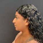 Rhinoplasty Before & After Patient #5365