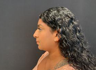Rhinoplasty Before & After Patient #5365