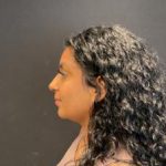 Rhinoplasty Before & After Patient #5365
