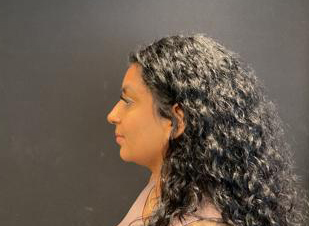 Rhinoplasty Before & After Patient #5365