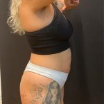 The Skinny Shot Before & After Patient #5599