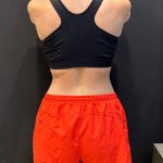 The Skinny Shot Before & After Patient #5600