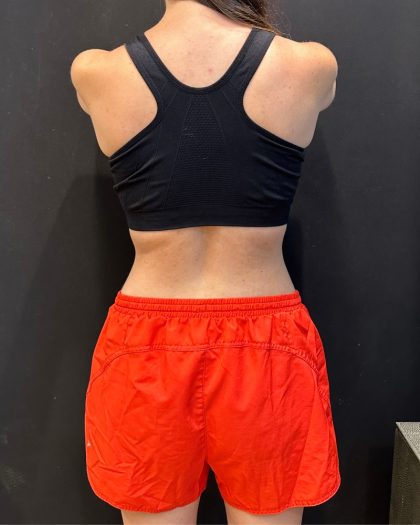 The Skinny Shot Before & After Patient #5600