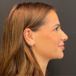Rhinoplasty Before & After Patient #5646
