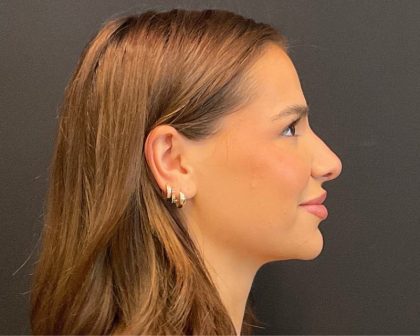 Rhinoplasty Before & After Patient #5646