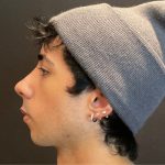 Rhinoplasty Before & After Patient #5647