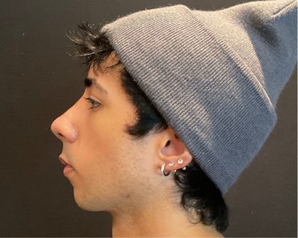 Rhinoplasty Before & After Patient #5647