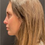 Rhinoplasty Before & After Patient #5648