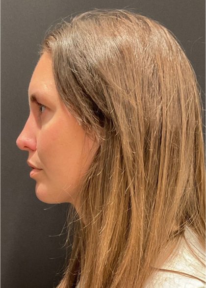 Rhinoplasty Before & After Patient #5648