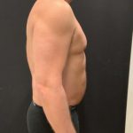 Liposuction Before & After Patient #6939