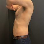 The Skinny Shot Before & After Patient #5479