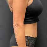 The Skinny Shot Before & After Patient #5475