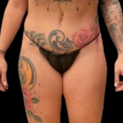 Butt Implants Before & After Patient #6840
