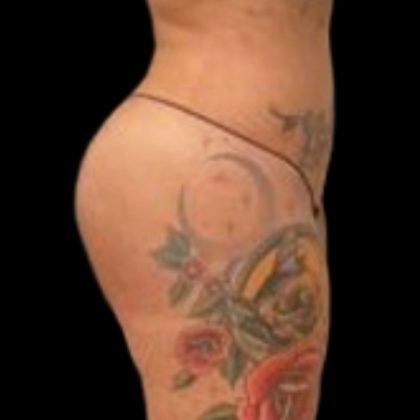 Butt Implants Before & After Patient #6840