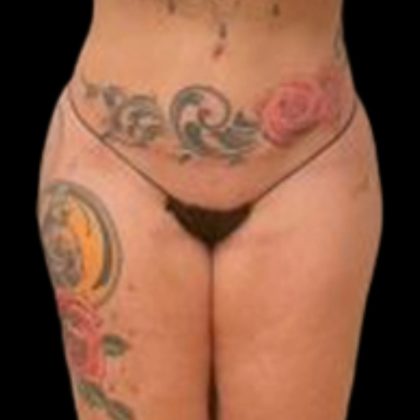 Butt Implants Before & After Patient #6840