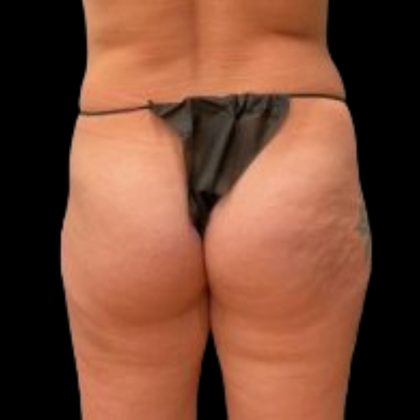Butt Implants Before & After Patient #6840