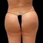 Butt Implants Before & After Patient #6840