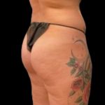 Butt Implants Before & After Patient #6840
