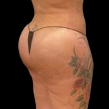 Butt Implants Before & After Patient #6840