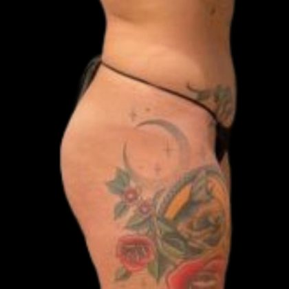 Butt Implants Before & After Patient #6840