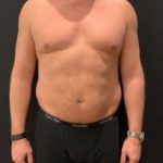 Liposuction Before & After Patient #6939