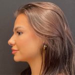 Rhinoplasty Before & After Patient #5646