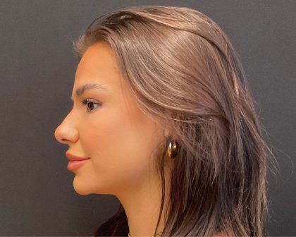 Rhinoplasty Before & After Patient #5646